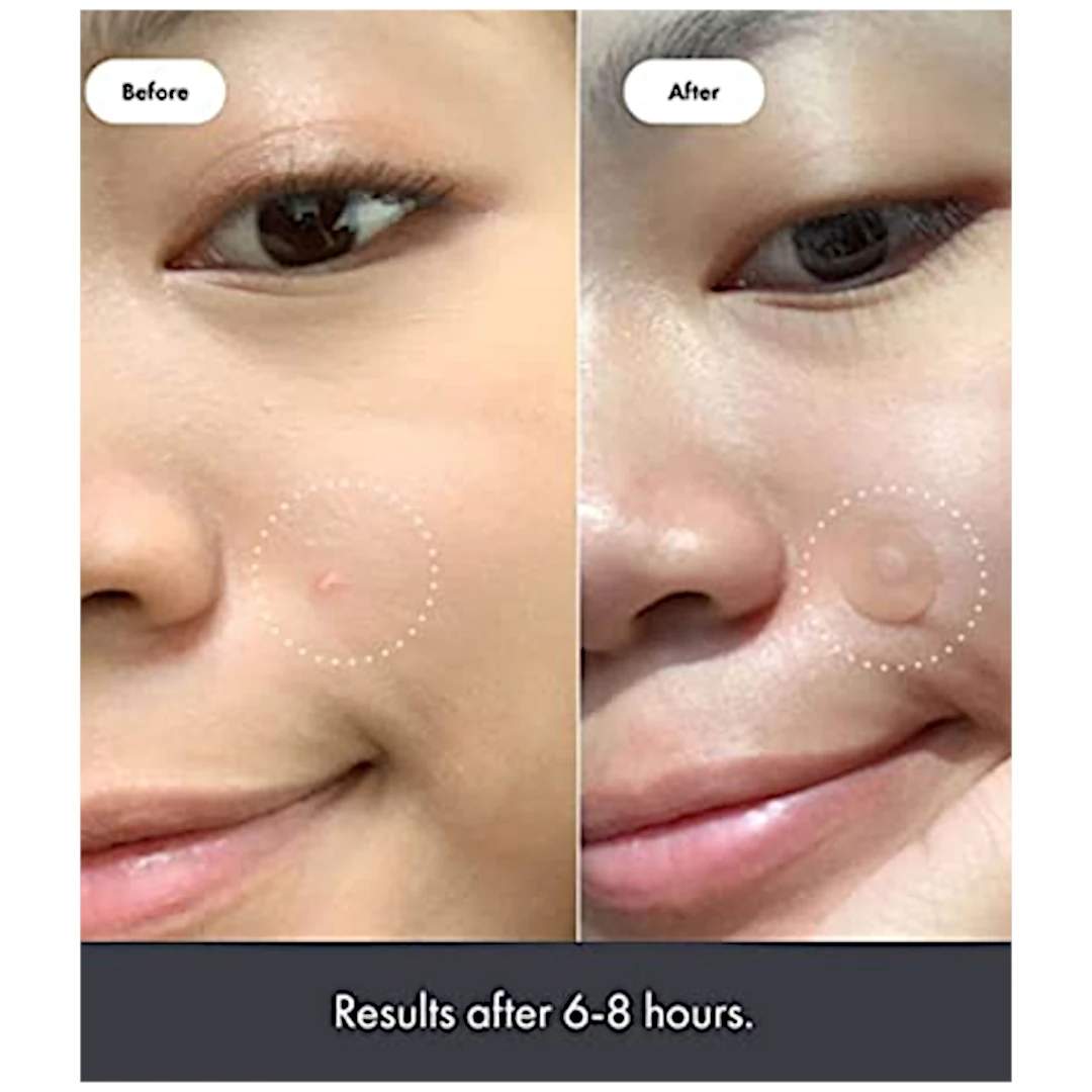 Hero Cosmetics Mighty Patch Acne Treatment - Image 4